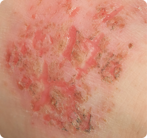Skin condition at Day 0 baseline — visible atopic dermatitis