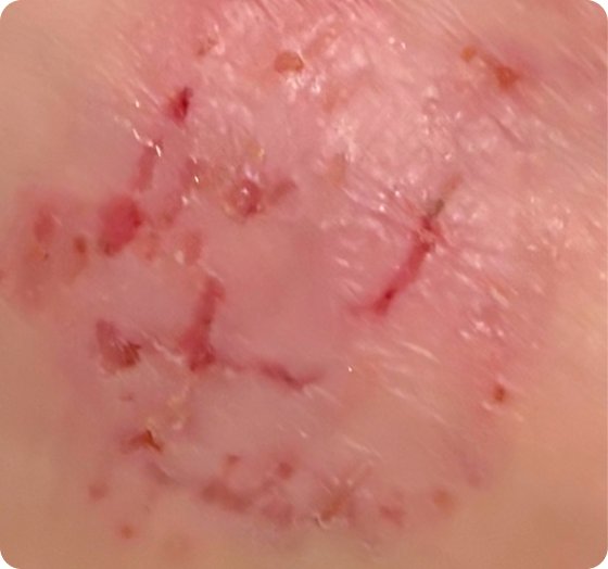 Skin condition at Day 2 — visible improvement after 48 hours